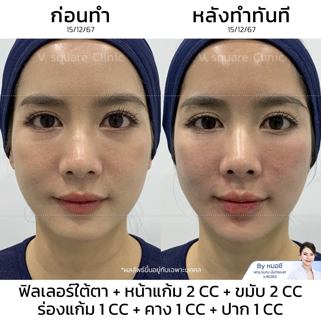 ฟิลเลอร์ขมับ รีวิว_คุณกุ๊กกิ๊ก