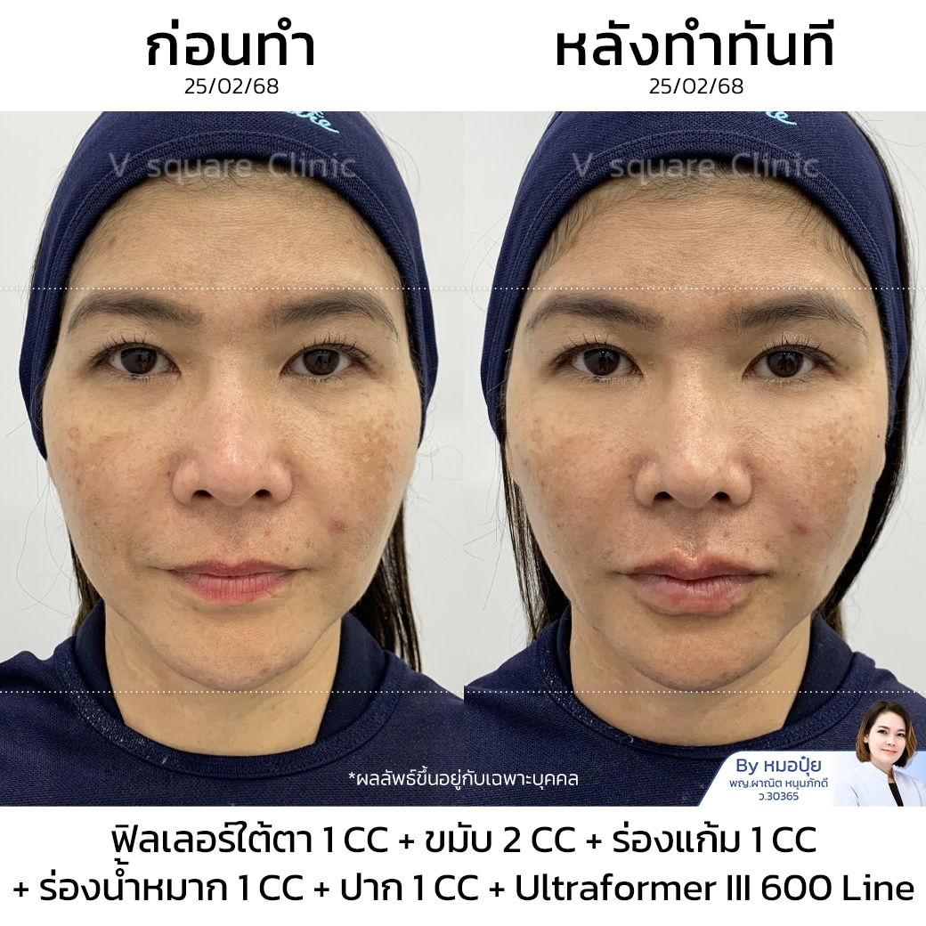 ฟิลเลอร์ขมับ รีวิว_คุณหมวย