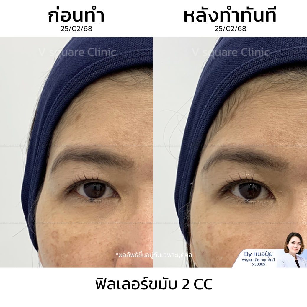 รีวิว ฟิลเลอร์ขมับ 2 cc_คุณหมวย