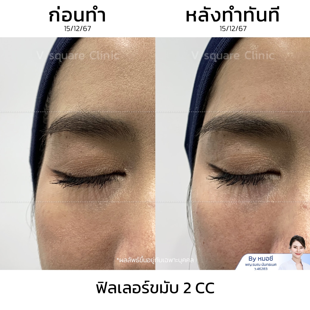 รีวิวฟิลเลอร์ขมับ_คุณกุ๊กกิ๊ก