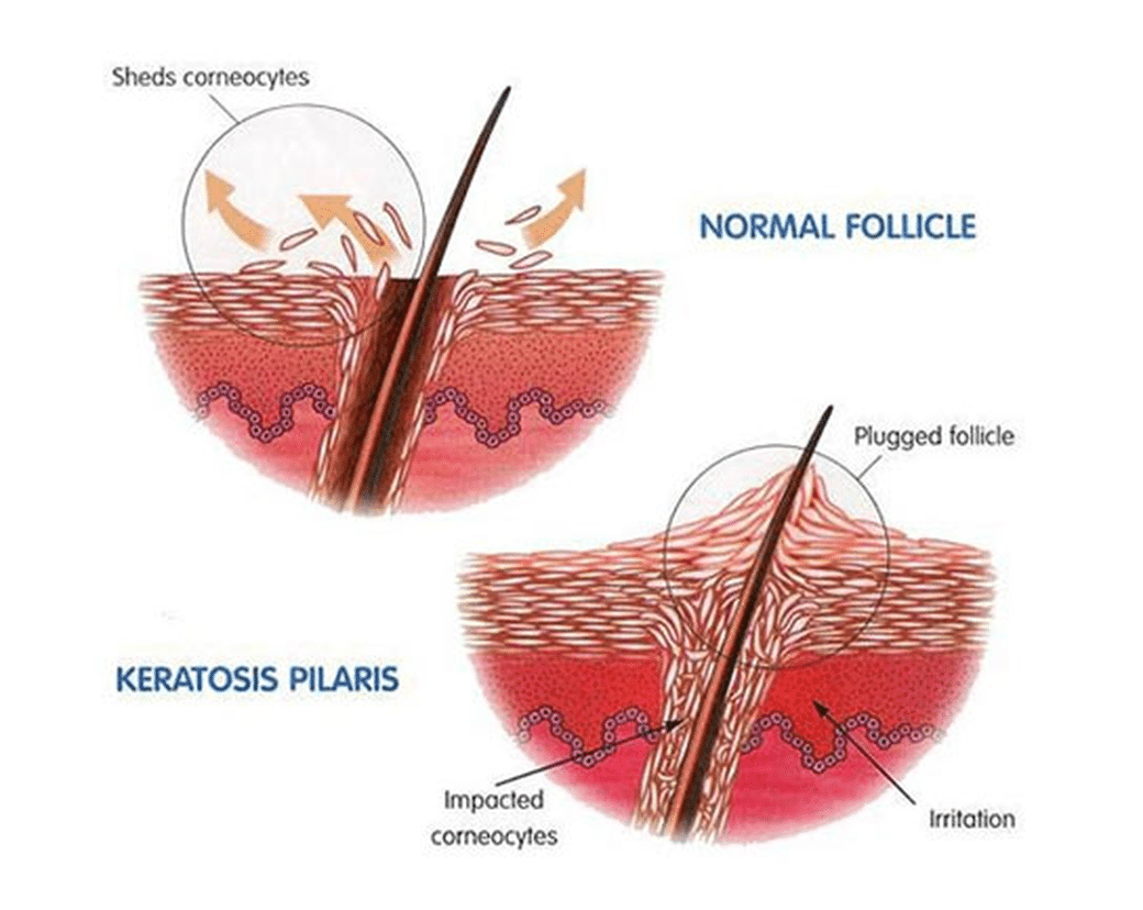 Keratosis Pilaris