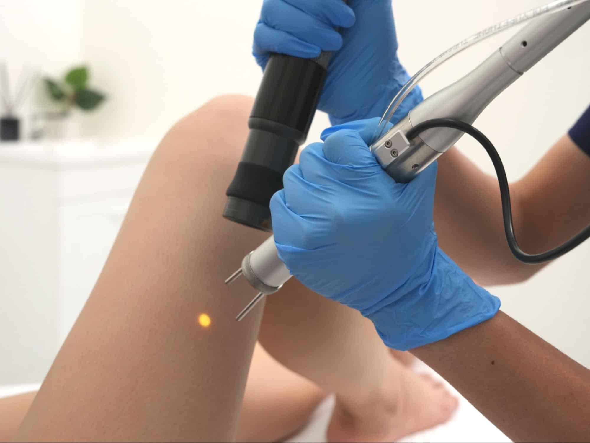 Yag Laser ที่ V Square Clinic
