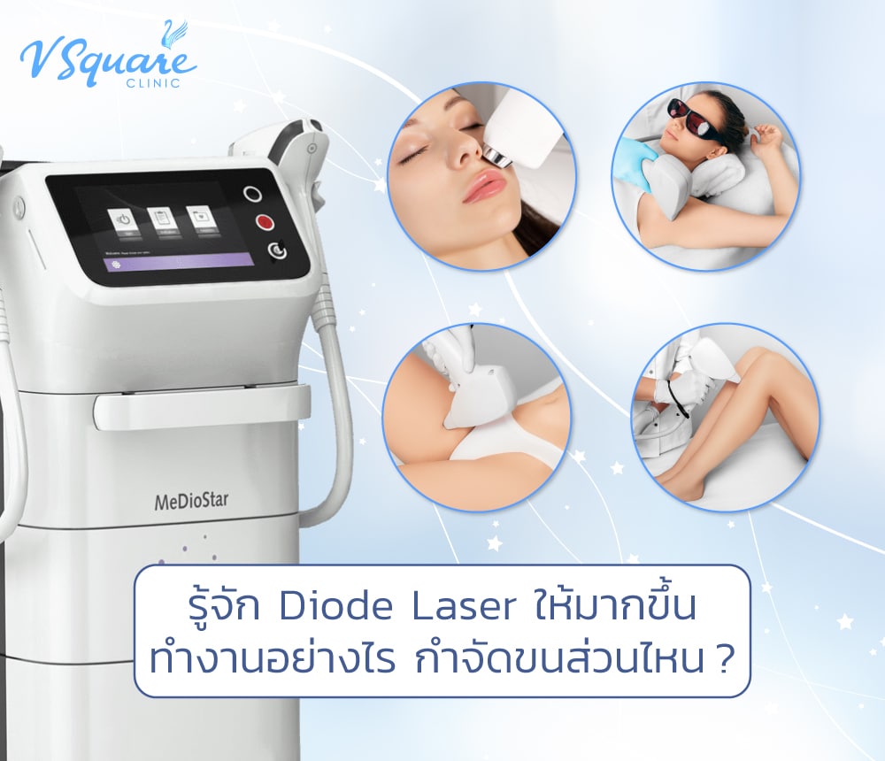 diode laser