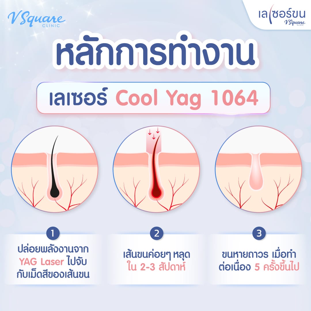 กระบวนการหลุดของเส้นขนจากการทำเลเซอร์