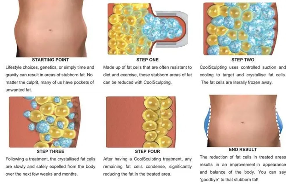 การทำงาน coolsculpting elite