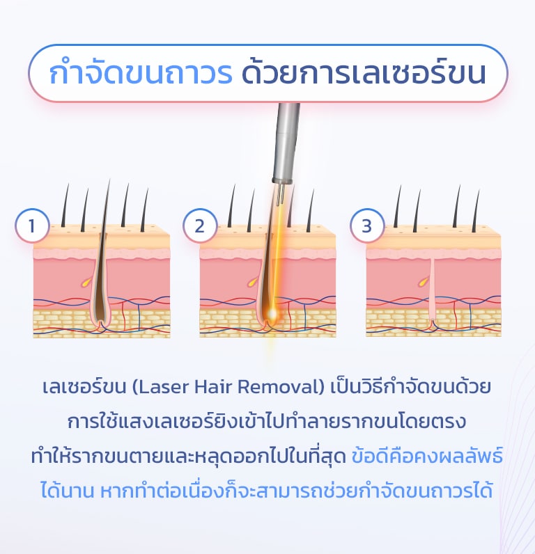 การทำงานของ diode laser