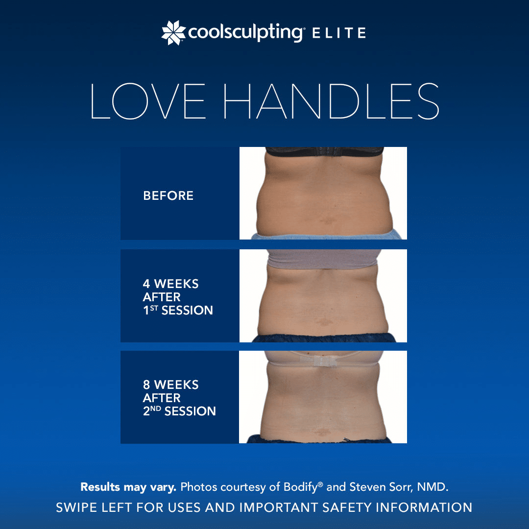 รีวิว coolsculpting elite