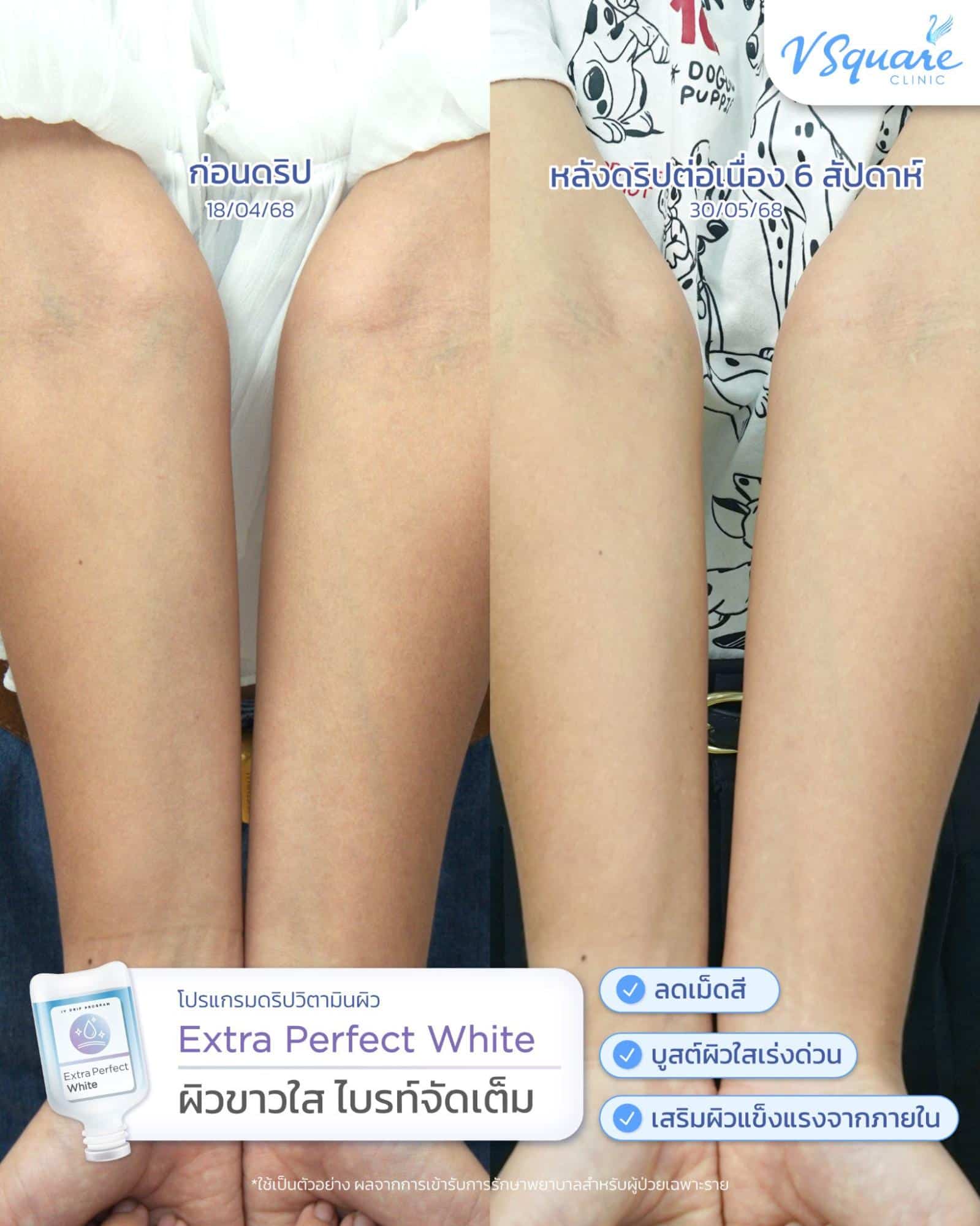 รีวิวผลลัพธ์หลังทำ IV drip ฟื้นฟูผิว