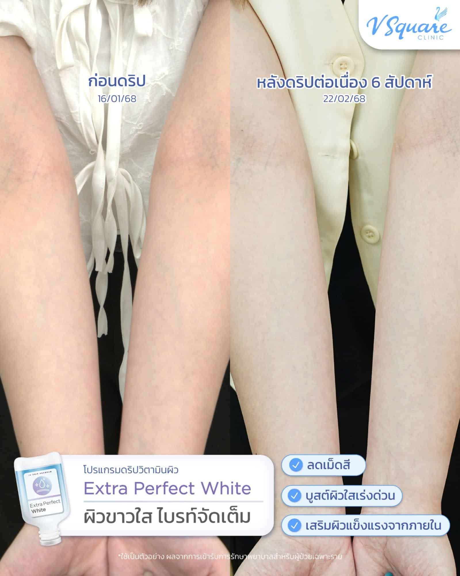 รีวิวผลลัพธ์หลังทำ IV drip