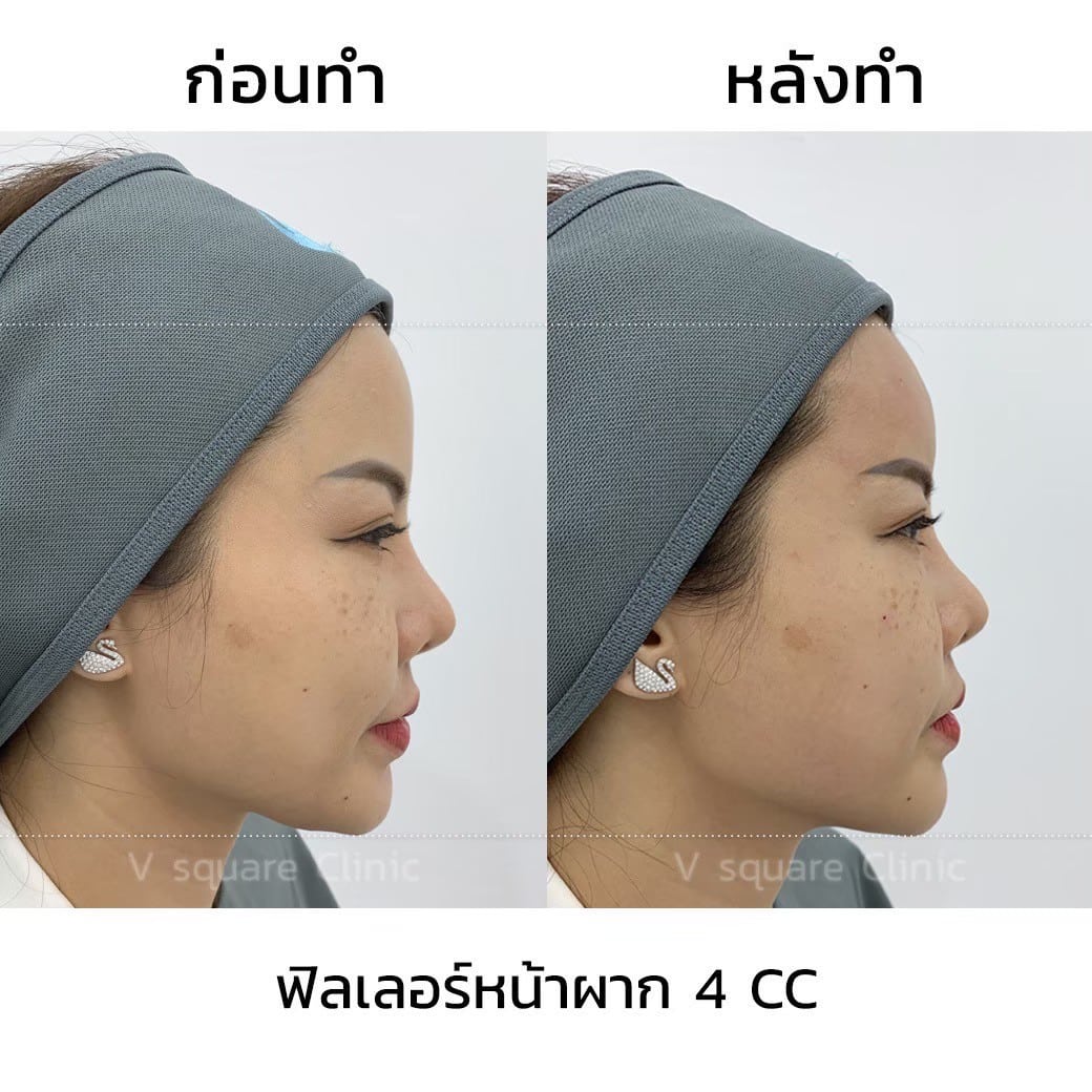 รีวิวฟิลเลอร์หน้าผาก 4 cc