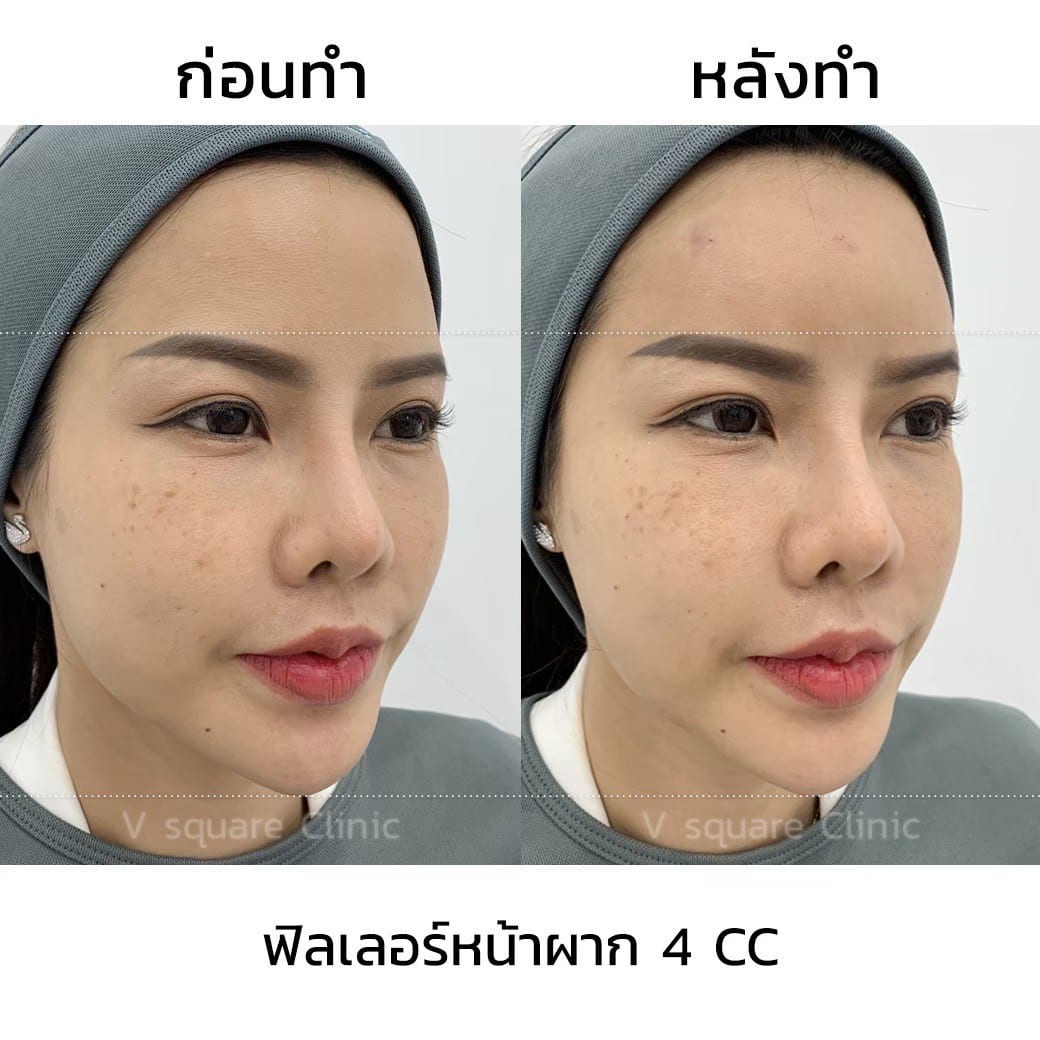 รีวิวฟิลเลอร์หน้าผาก