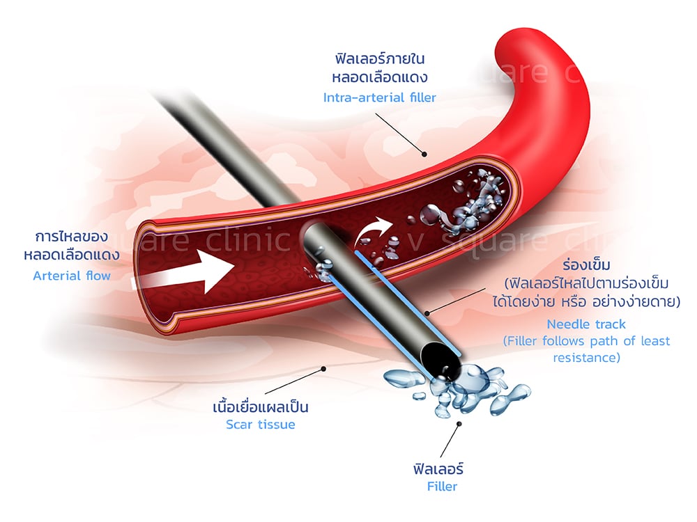 ฟิลเลอร์อุดตันเส้นเลือด