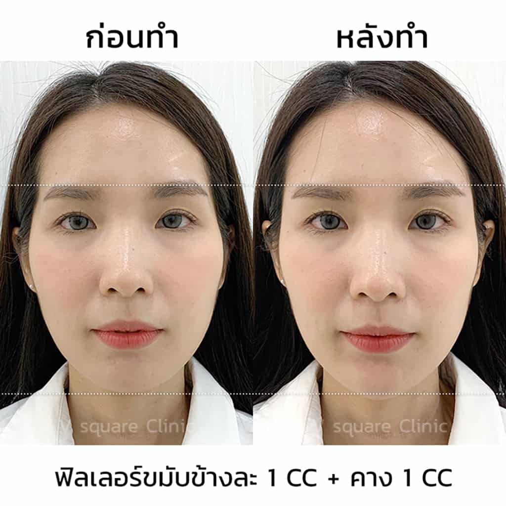 ฉีดฟิลเลอร์คาง 1 CC รีวิว