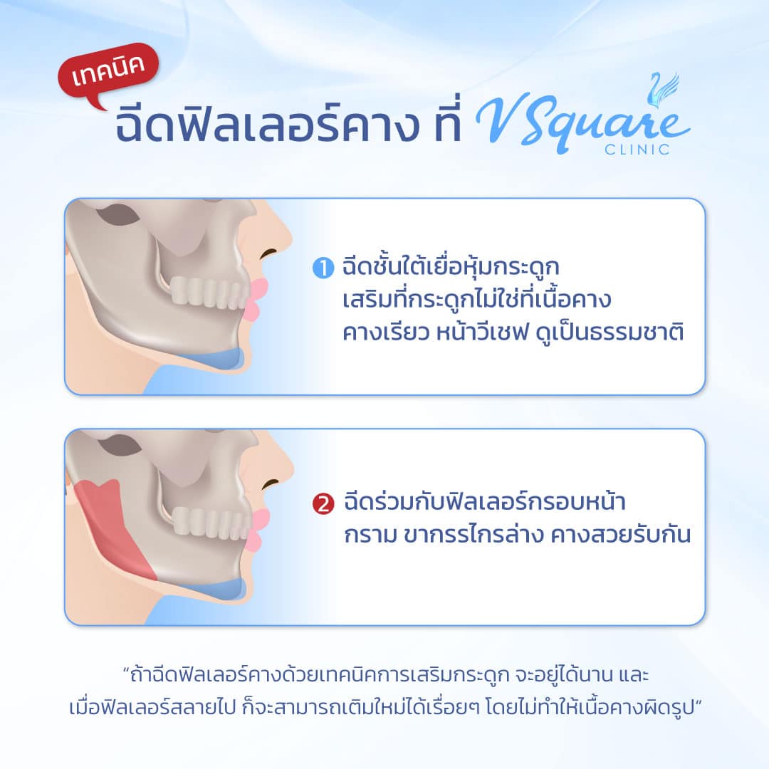 ฉีดฟิลเลอร์คางเทคนิคเดียวกับการผ่าตัด