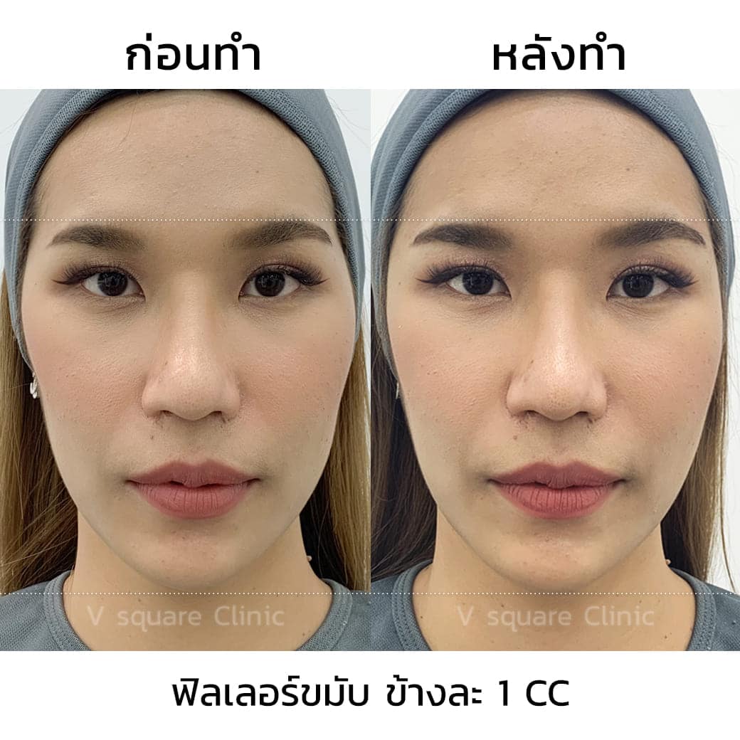 ฟิลเลอร์ขมับ 2 cc