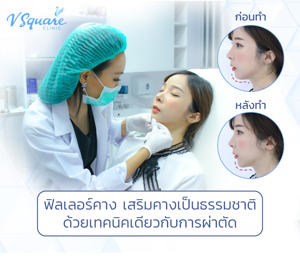 ฟิลเลอร์คาง