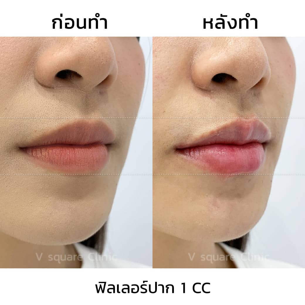 ฟิลเลอร์ปาก 1 cc รีวิว