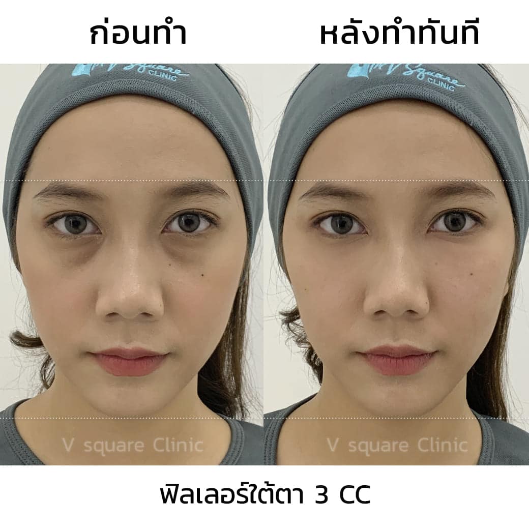 ฟิลเลอร์ใต้ตา 3 cc