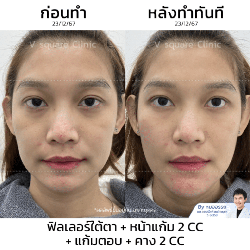 รีวิว ฉีดฟิลเลอร์คาง แก้คางสั้น