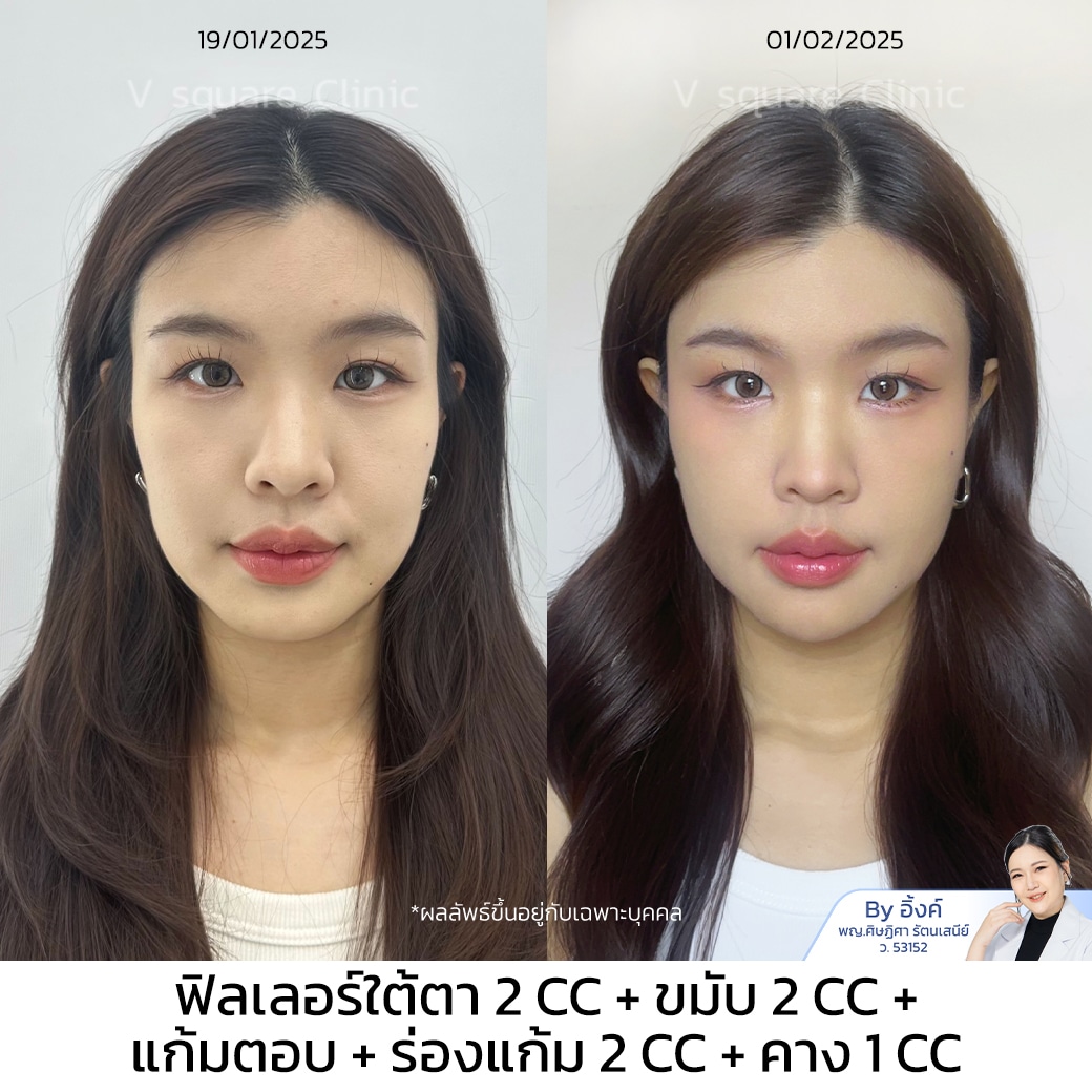 รีวิว ฉีดฟิลเลอร์คางคุณน้ำ