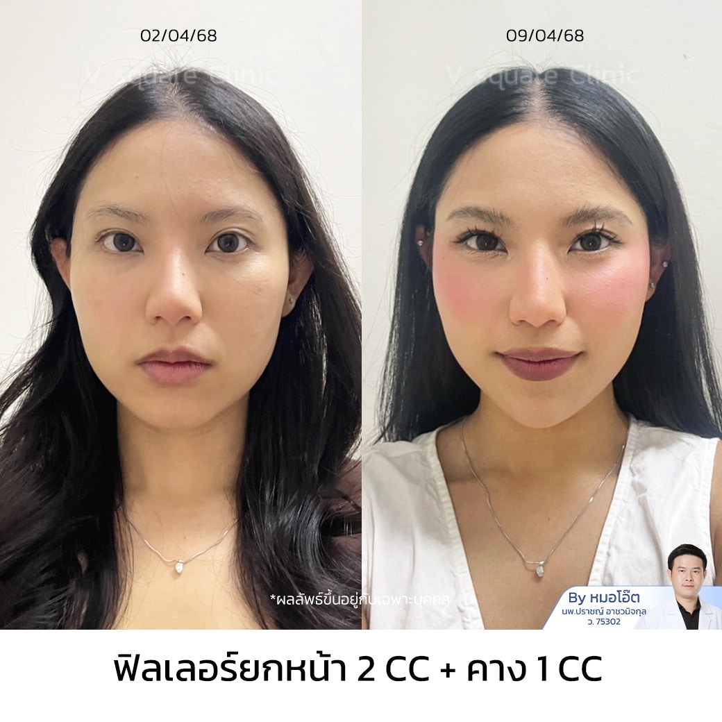 รีวิว ฉีดฟิลเลอร์คางคุณแบมบู
