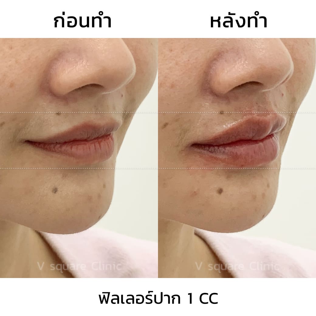 รีวิว ฟิลเลอร์ปาก 1 CC