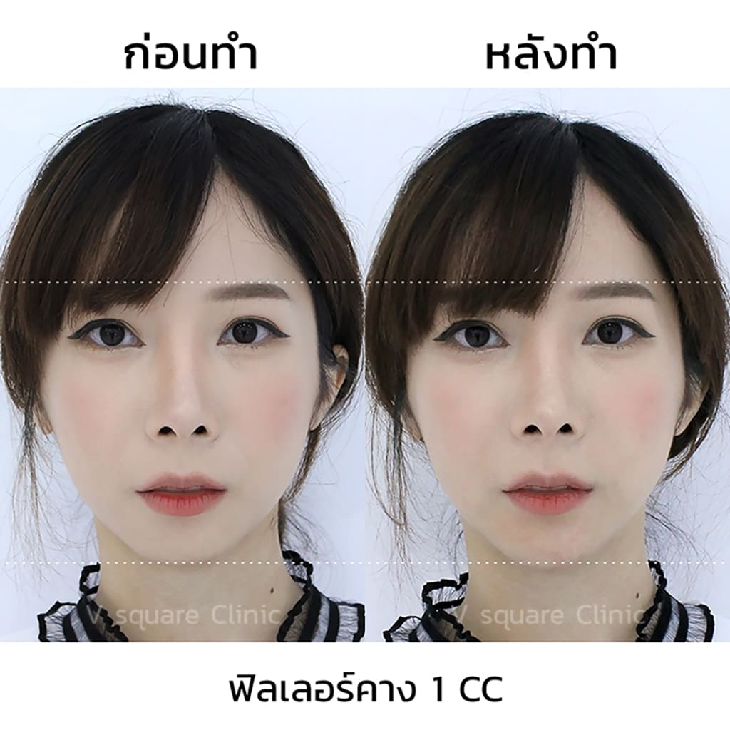 รีวิวฉีดฟิลเลอร์คาง 1 CC