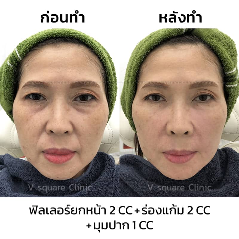 รีวิวฟิลเลอร์ยกหน้า