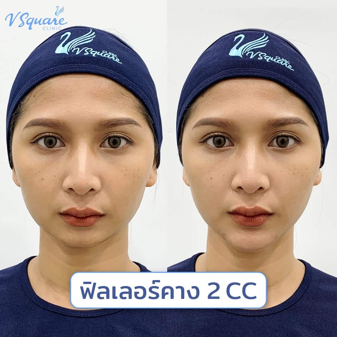 รีวิวเติมคาง