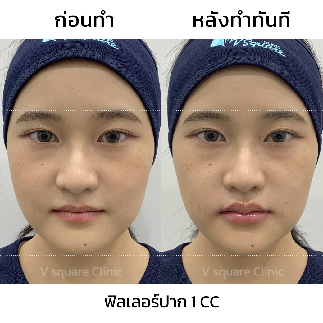 รีวิว ฟิลเลอร์ปาก 1 CC