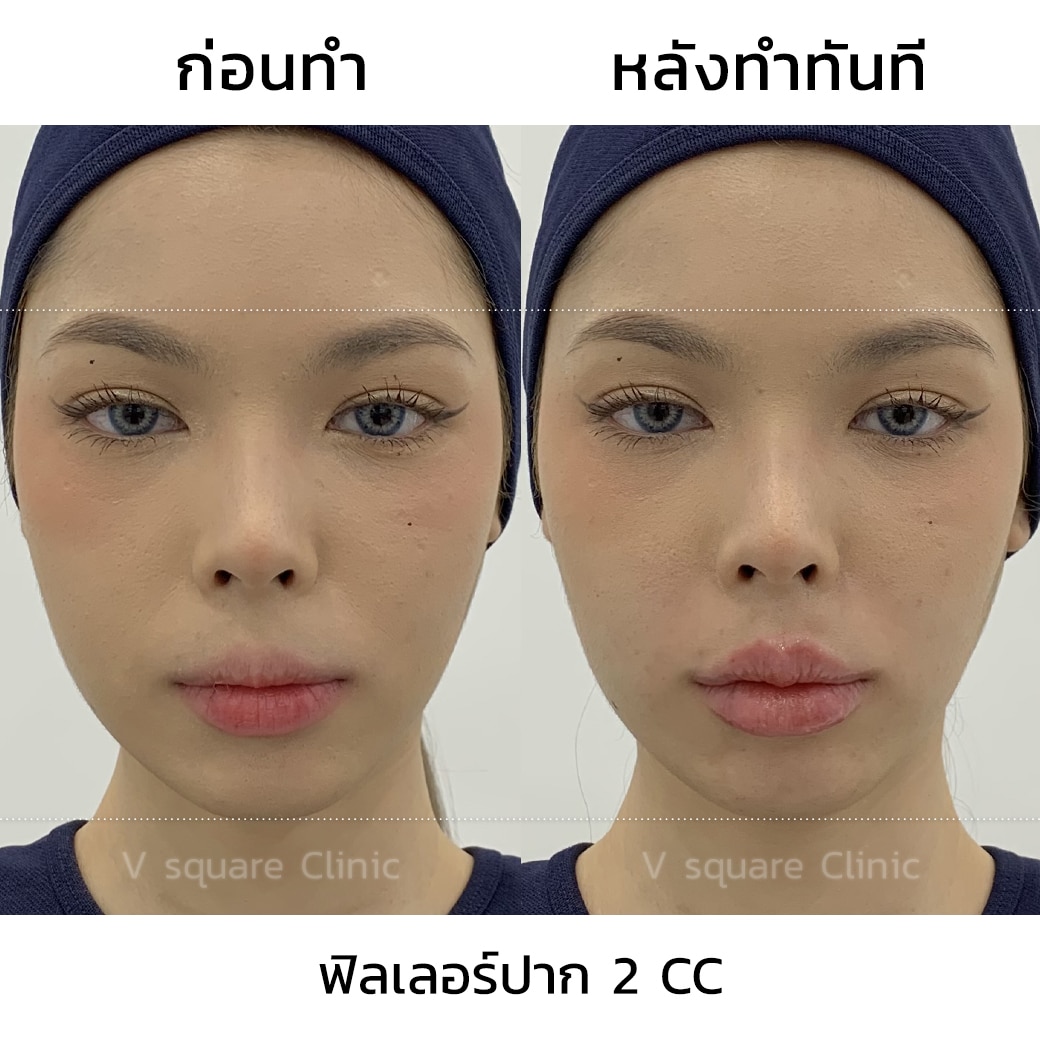 รีวิว ฟิลเลอร์ปาก 2 CC