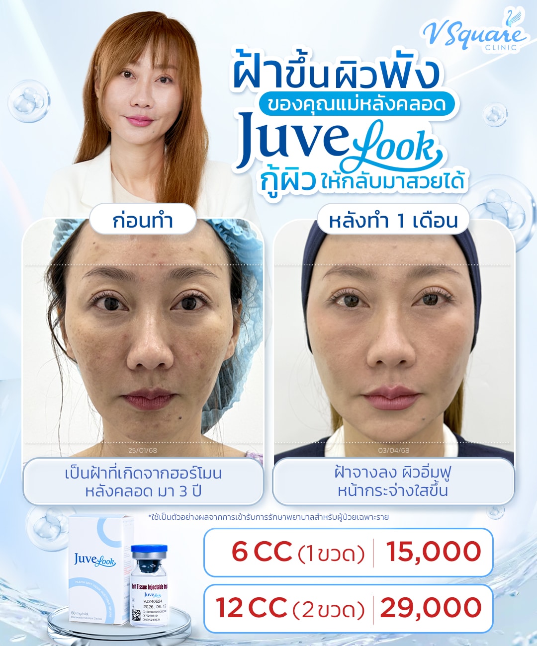 รีวิวฉีด Juvelook งานผิว