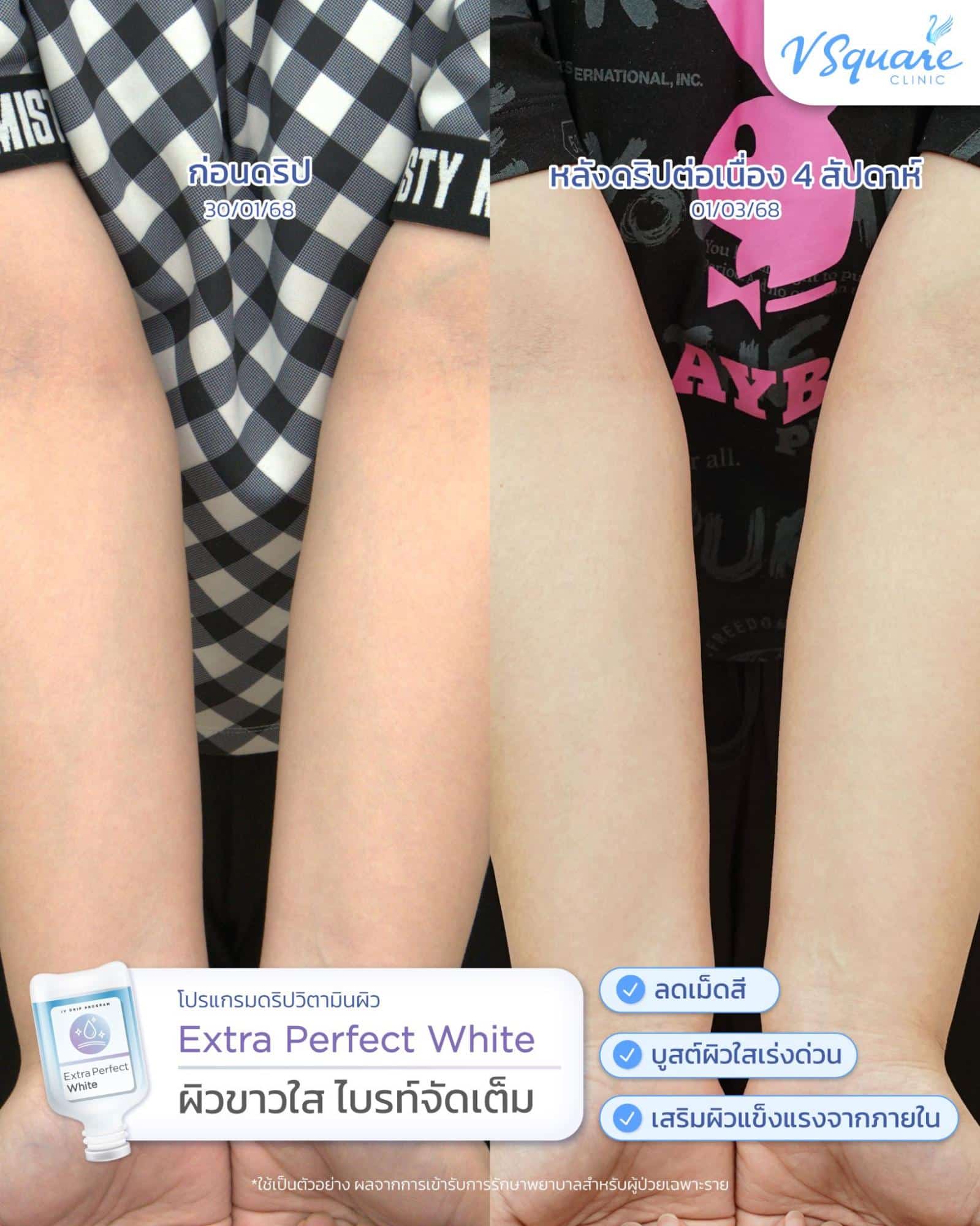 รีวิวดริปวิตามินผิวขาว