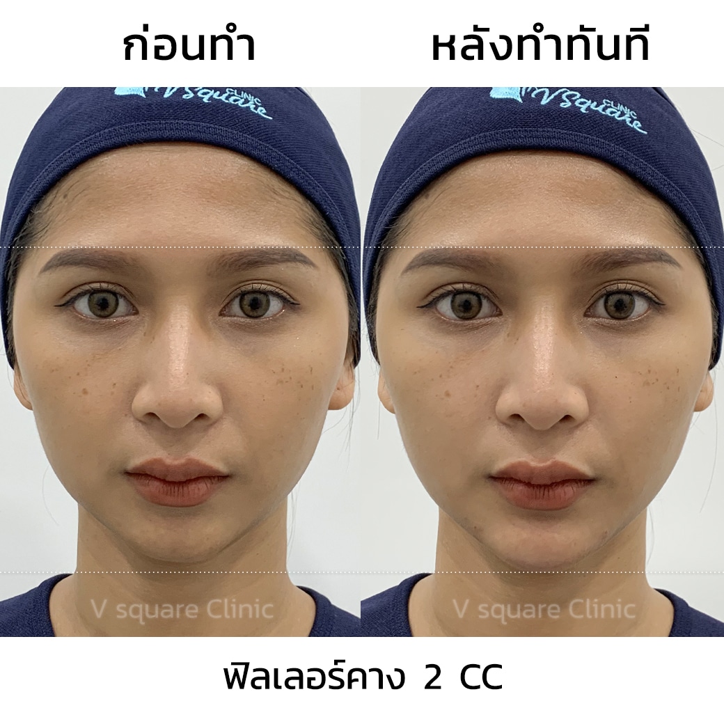 รีวิวหลังฉีดคาง