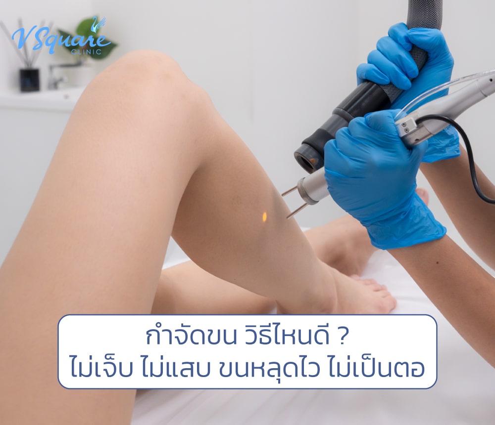 กำจัดขน