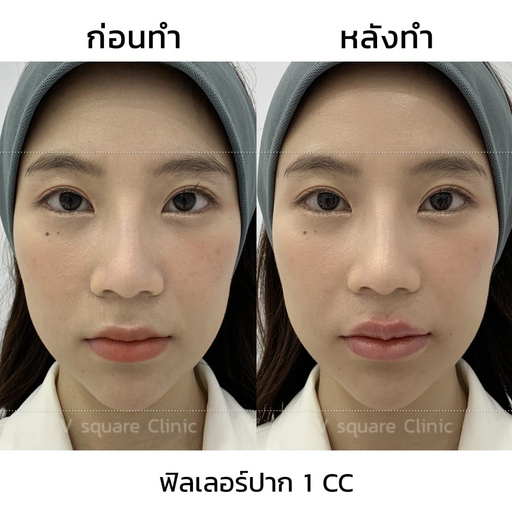 ปากแห้งแตกขาดวิตามินอะไร ? สาเหตุ อาการ วิธีรักษา