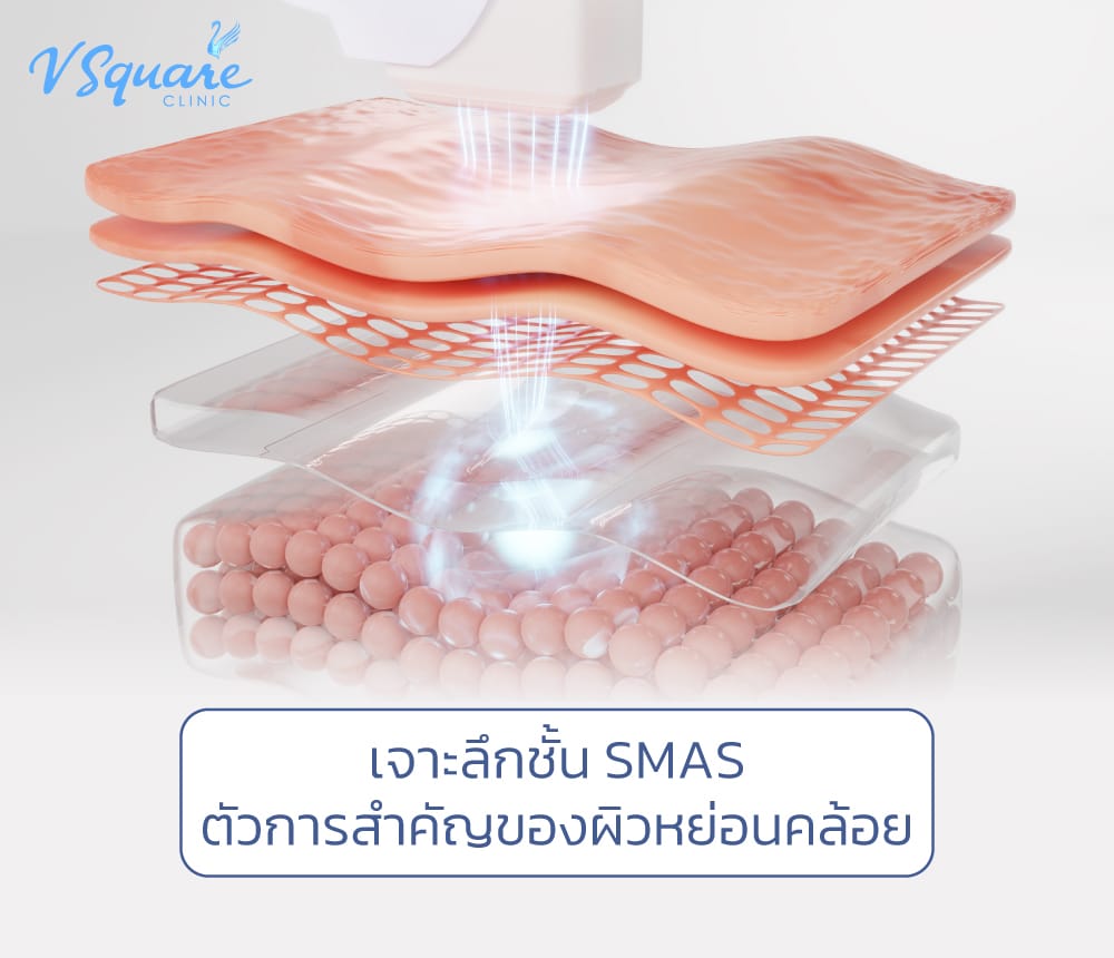 SMAS