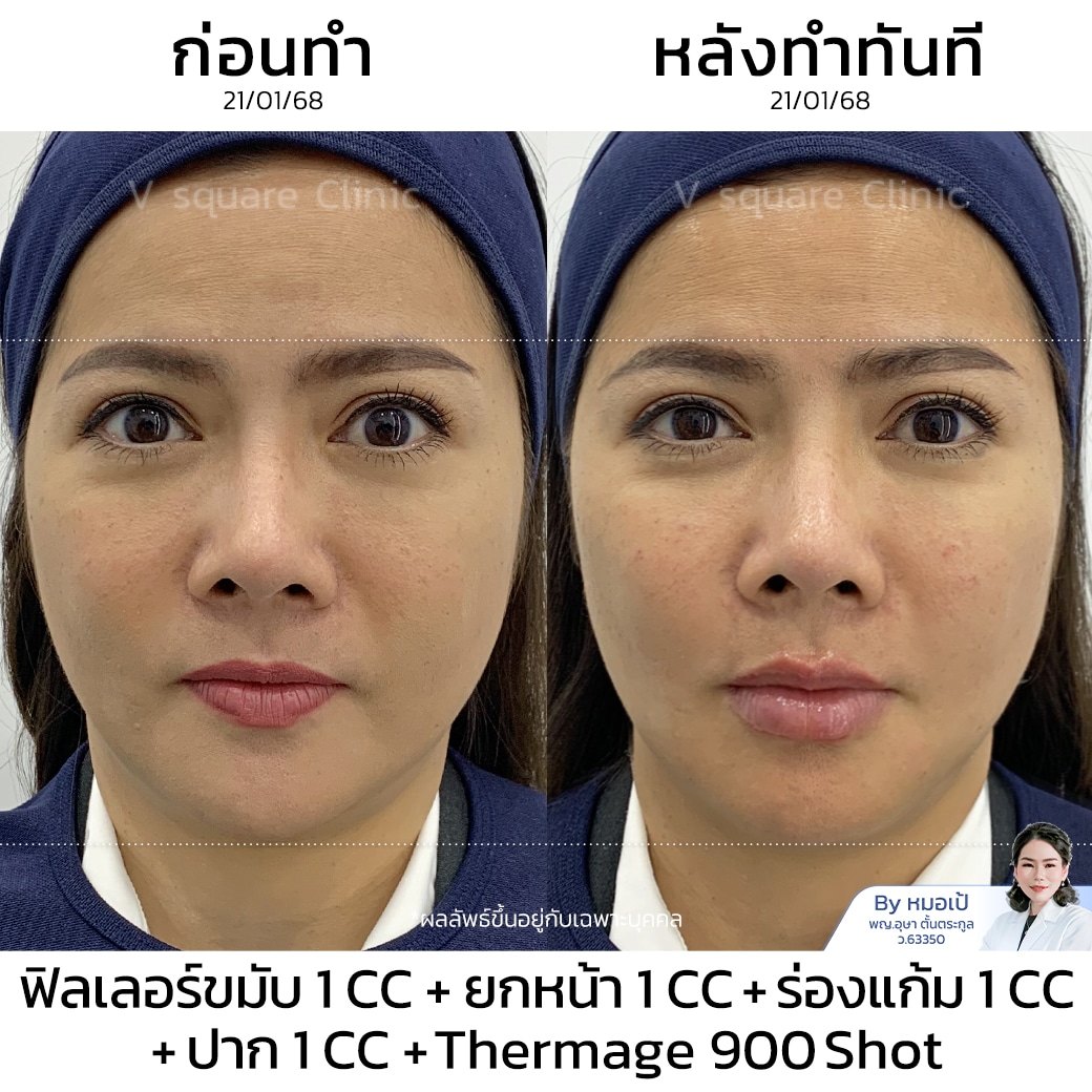 รีวิว Thermage_พี่ปุ้ย_(Content โหนกระแส)