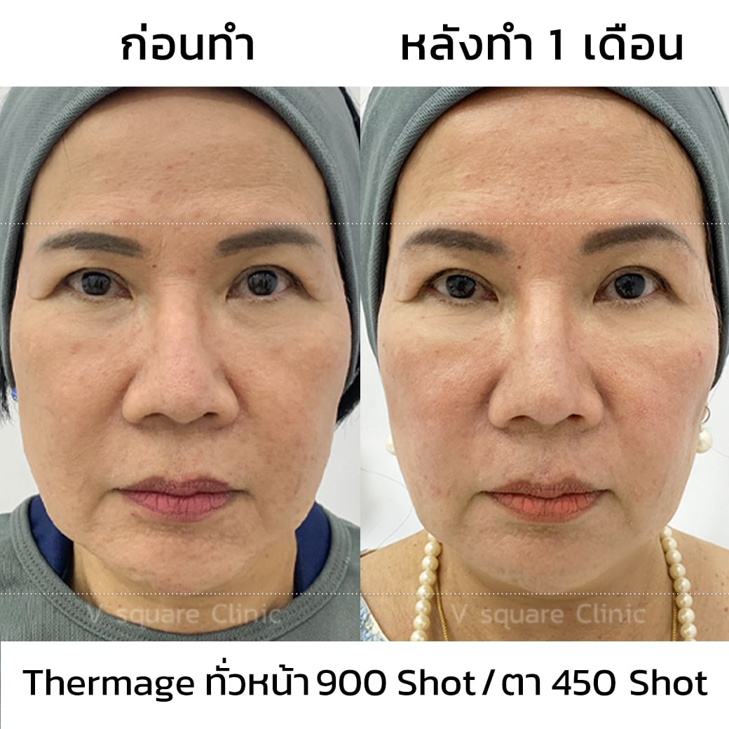 รีวิว Thermage_แม่อ๋อย