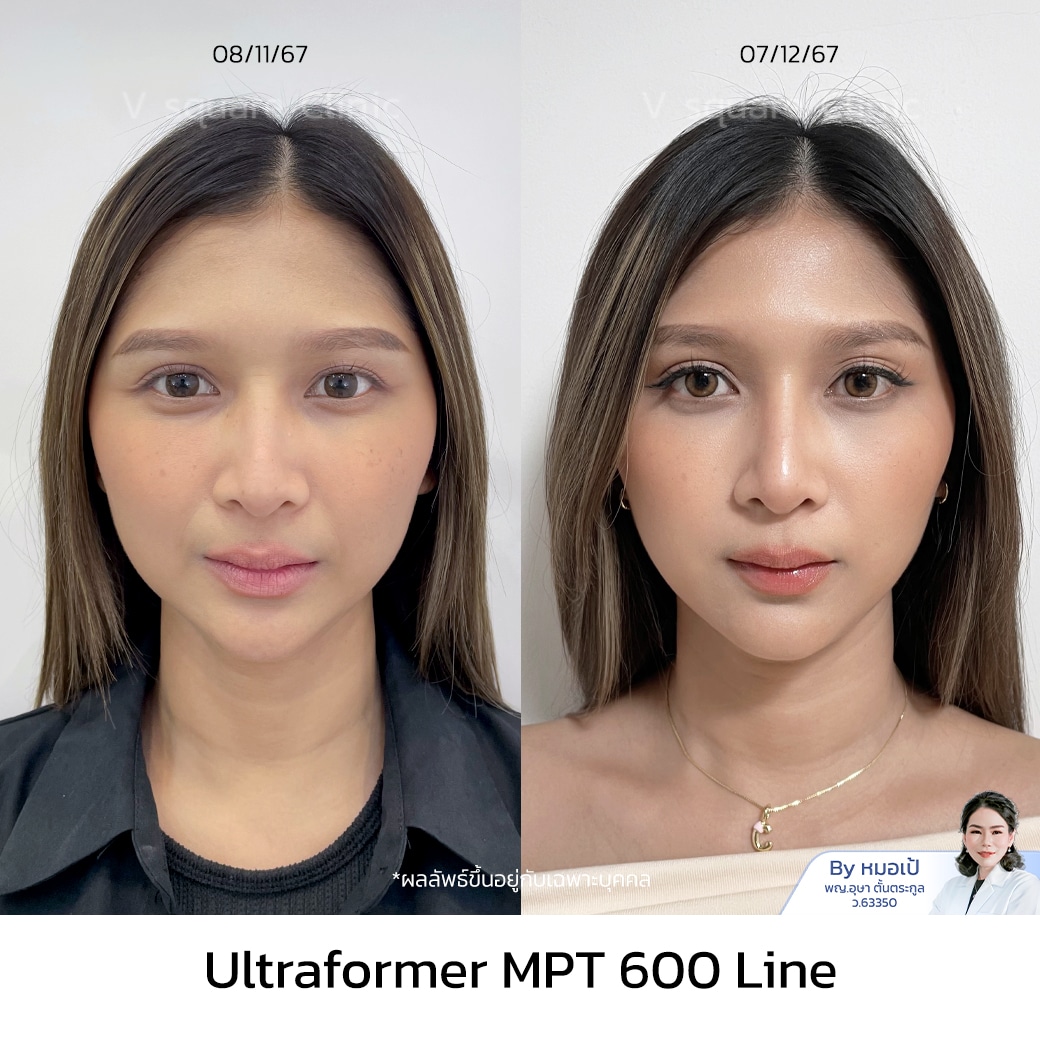 รีวิว Ultraformer MPT_พี่ครีม