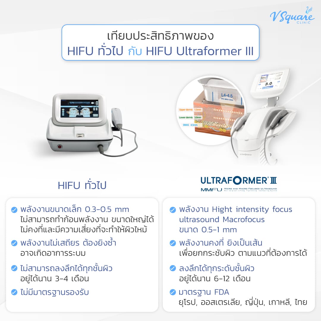 Hifu ทั่วไป vs Hifu Ultraformer III
