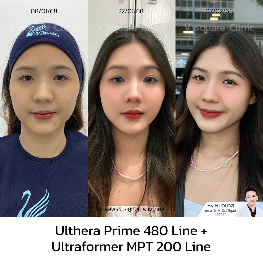 รีวิว Ulthera Prime ราคาคุ้มค่า_เอิร์น UL RR+MPT