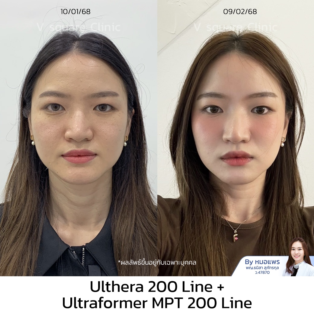 Ulthera รีวิว ฟิว