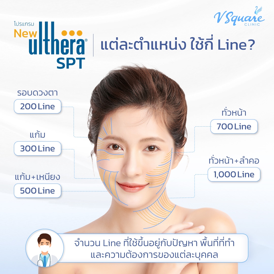 ทำ Ulthera SPT แต่ละตำแหน่งใช้กี่ช็อต