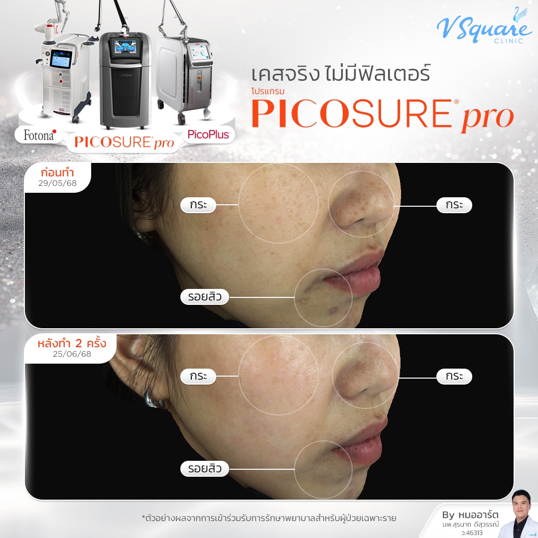 รีวิว Pico_คุณนัน