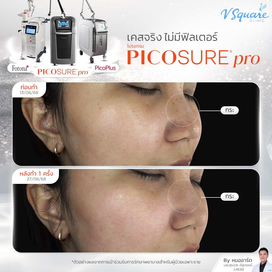 รีวิว Pico_คุณเป็ก