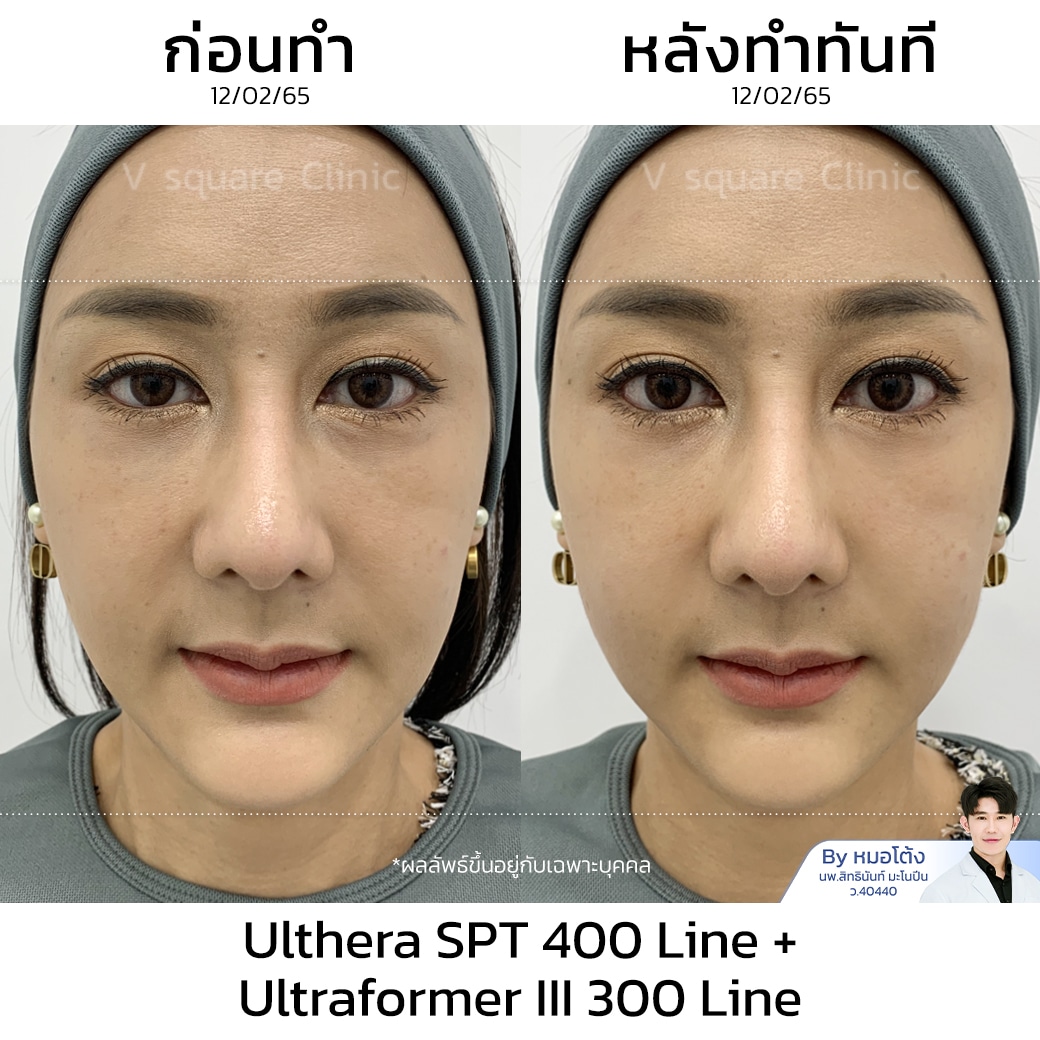 รีวิว Ulthera 300line