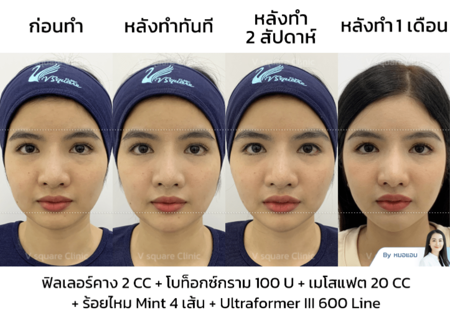 รีวิว Ultraformer III_คุณซานตี้ Influencer โดยพญ.กรกนก