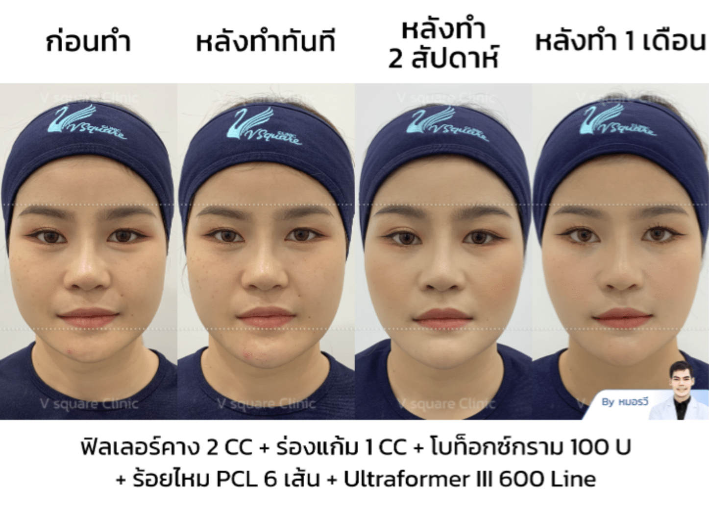 รีวิว Ultraformer III_คุณหญิง Influencer โดยนพ.รวี