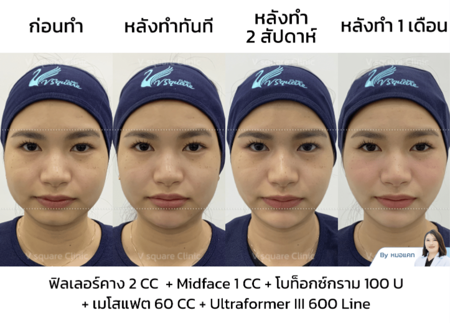 รีวิว Ultraformer III_คุณเนย Influencer โดยพญ.คัทลียา
